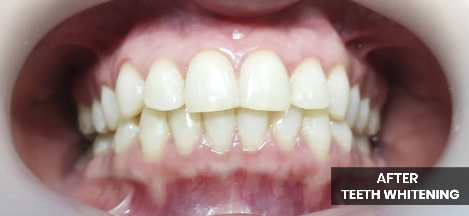 after teeth whitening 1600x738