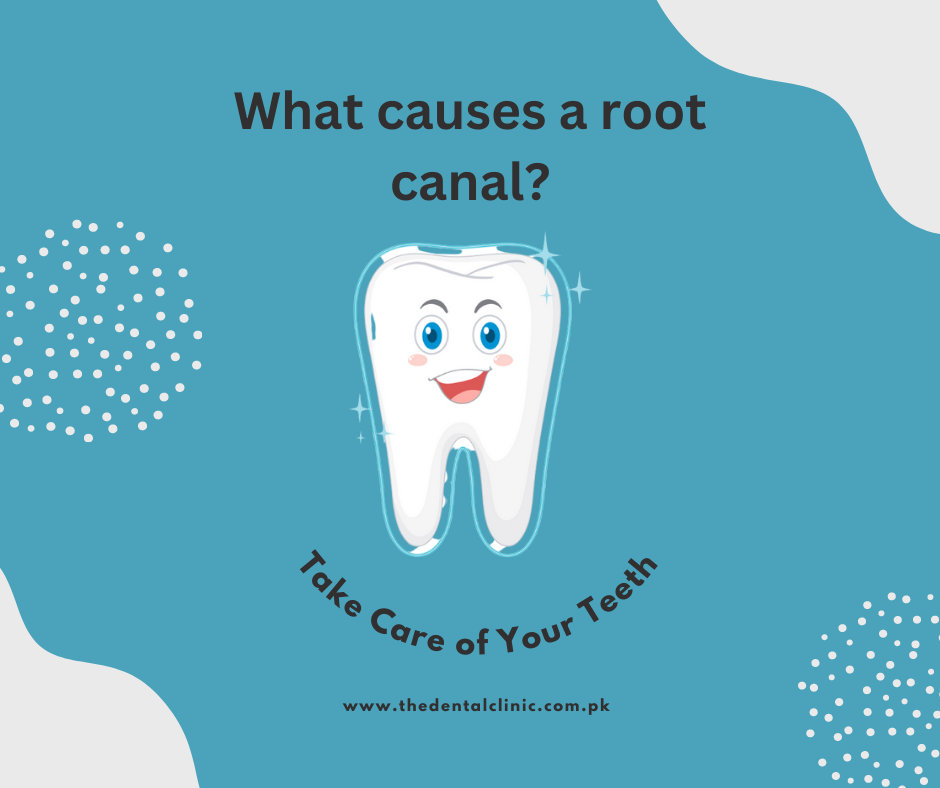 What causes a root canal? Understanding the reasons behind root canal treatment