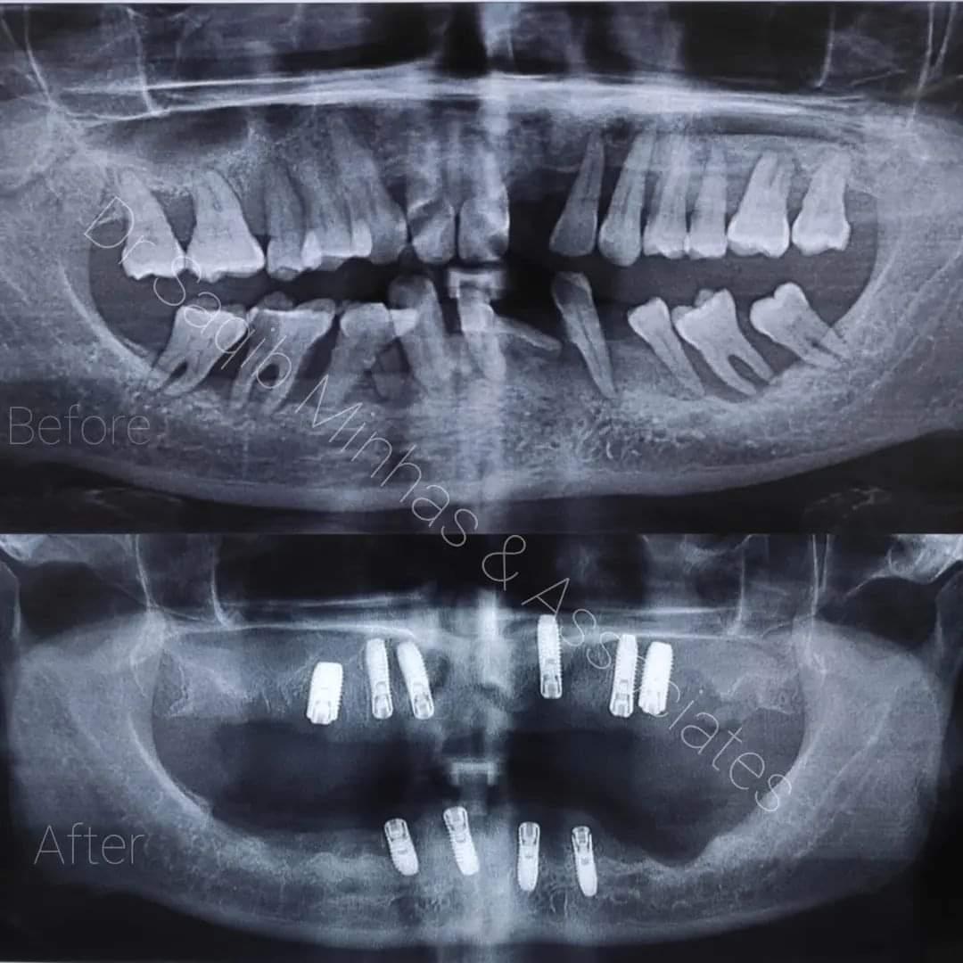 Full Mouth Rehabilitation With Implant & Bridges