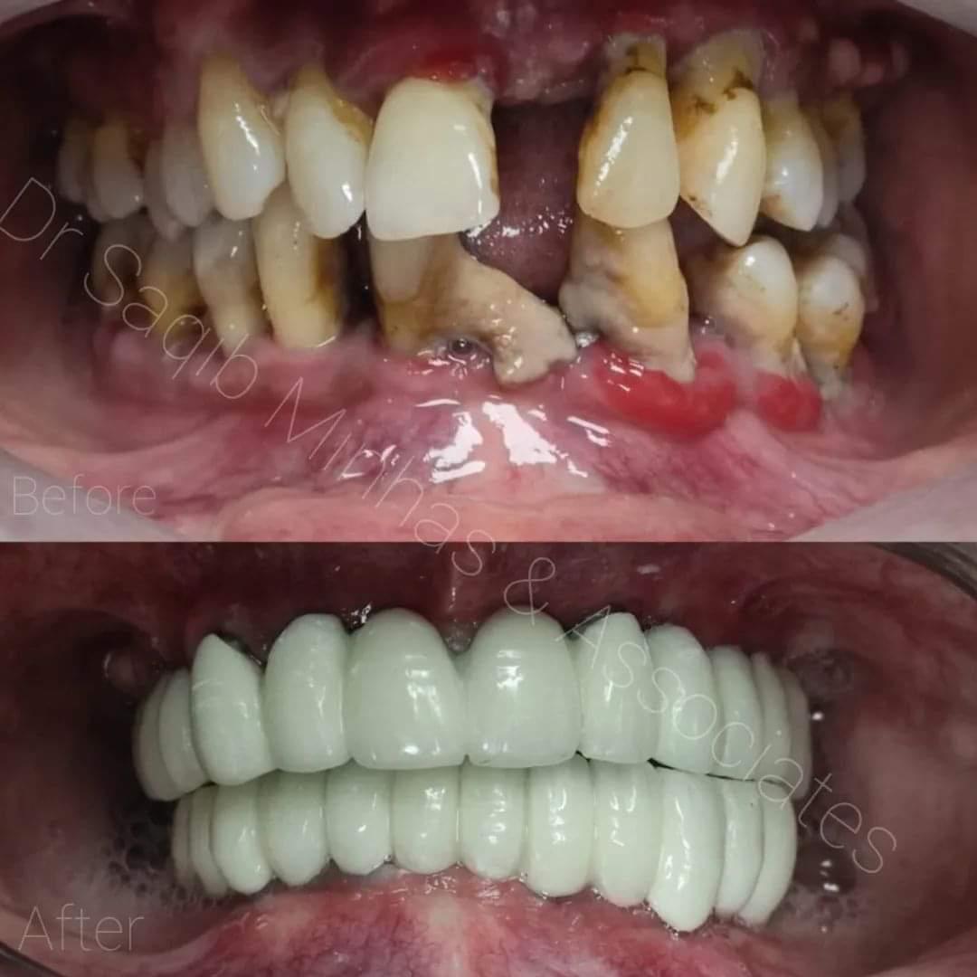 Full Mouth Rehabilitation With Implant & Bridges