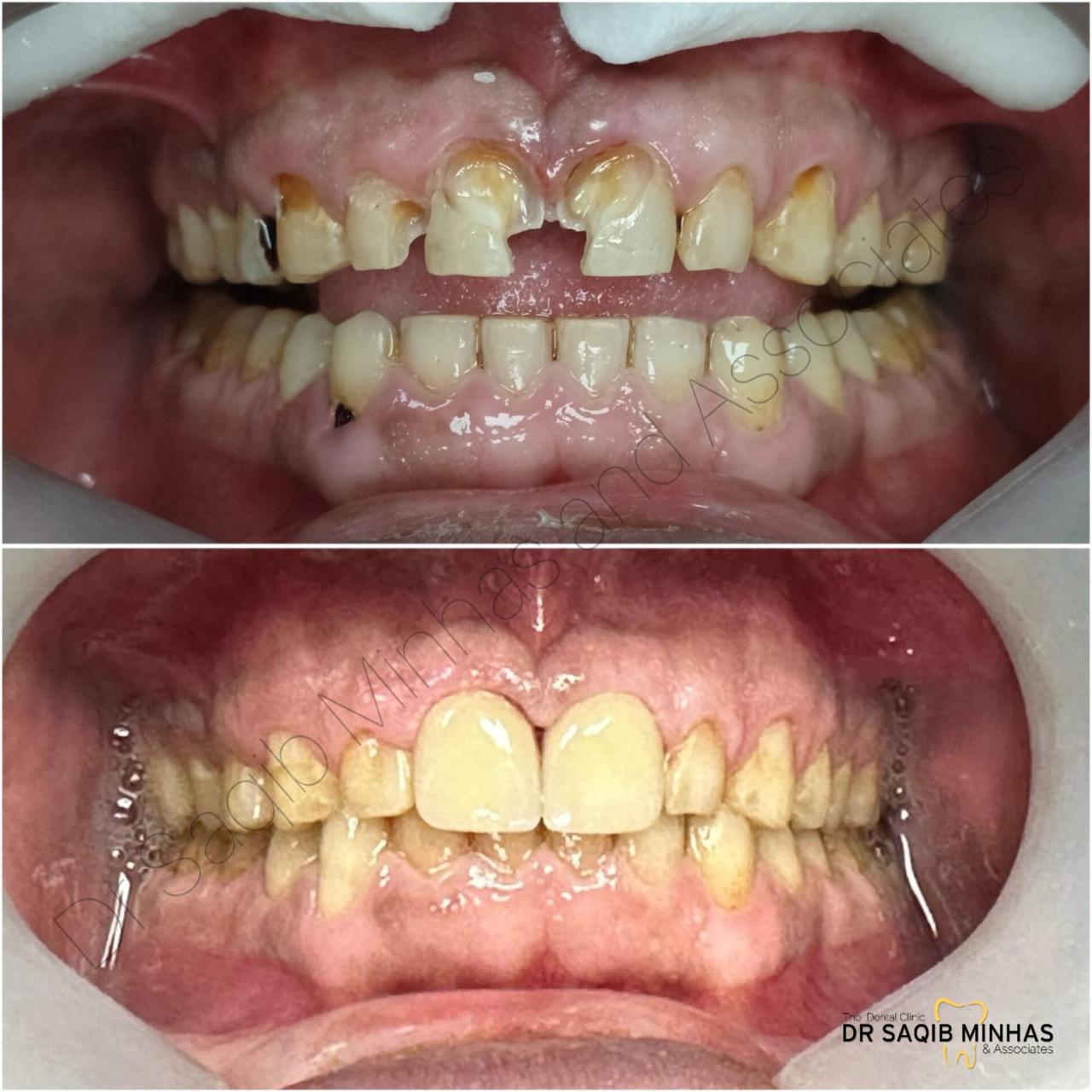 Restored Smile With Fillings & Zirconium Crowns
