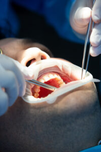 Tooth Extraction Services in Karachi