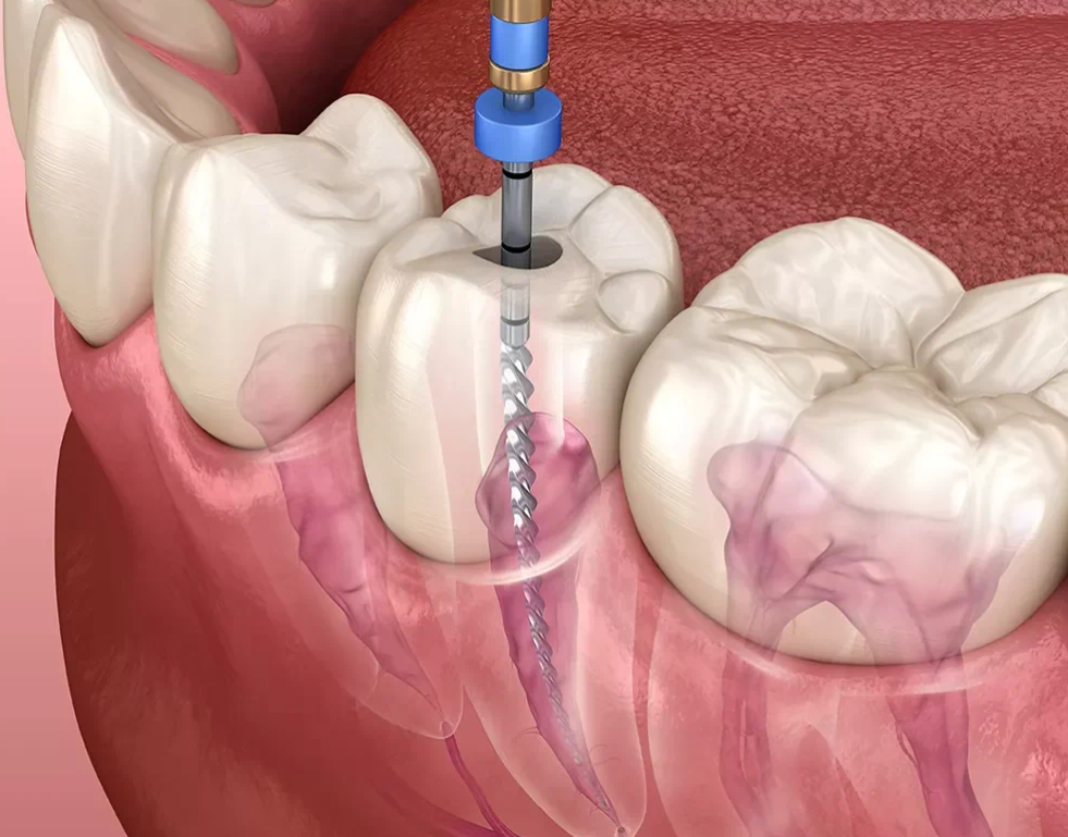Root canal treatment services at The Dental Clinic