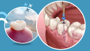 Root canal treatment procedure at The Dental Clinic