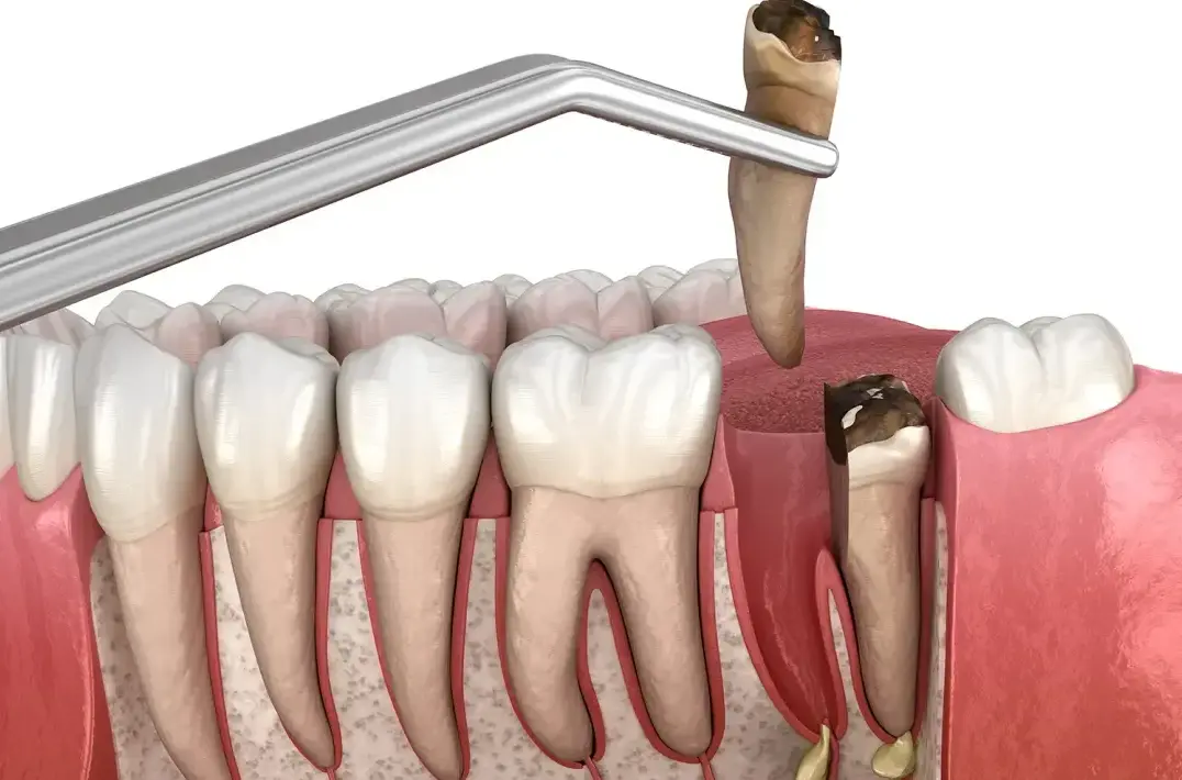 best dentists for tooth extraction