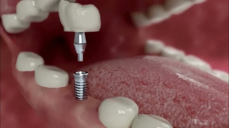 best dentists for dental implants