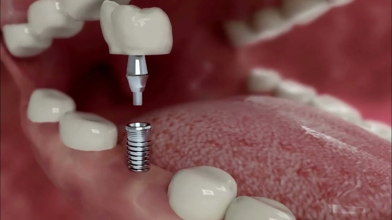 best dentists for dental implants