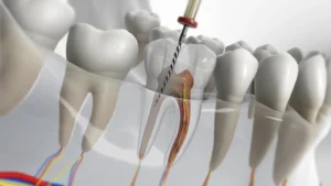 best dentists for root canals