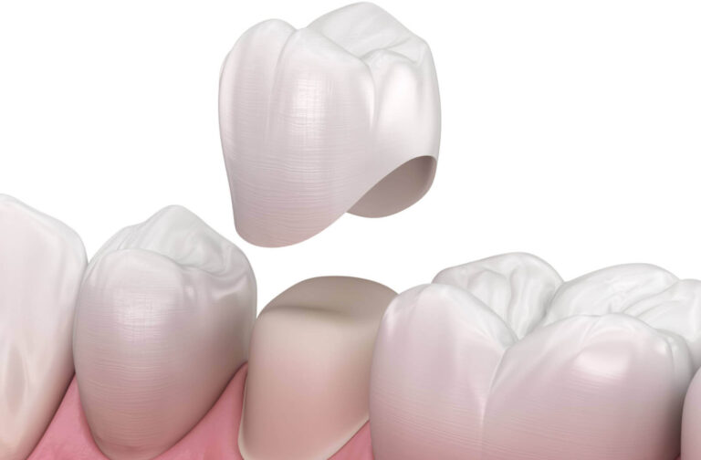 Dental crown after a root canal treatment