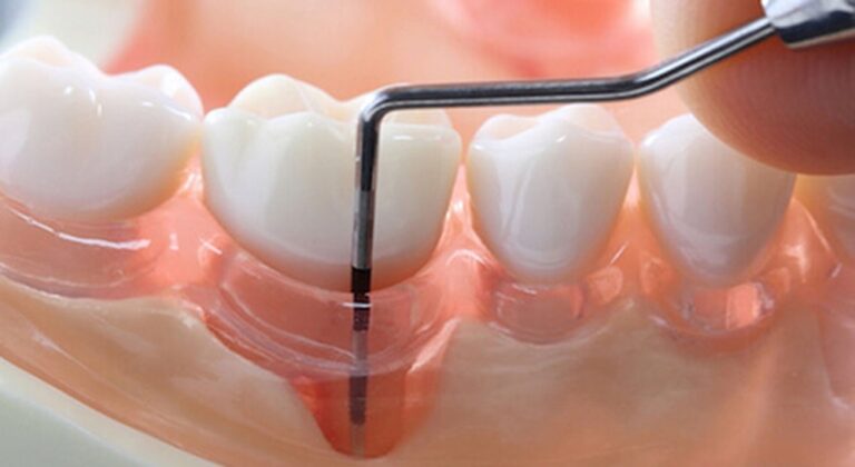 teeth currettage karachi