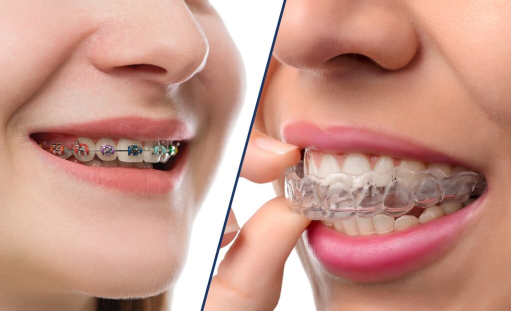 aligners-or-braces