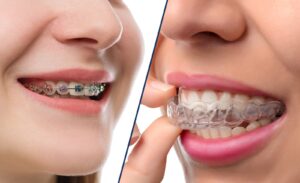 aligners-or-braces