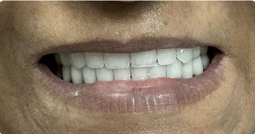 denture after