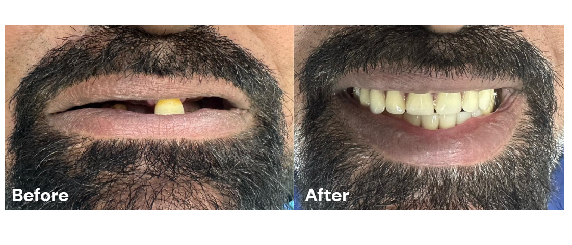 dental implant case study