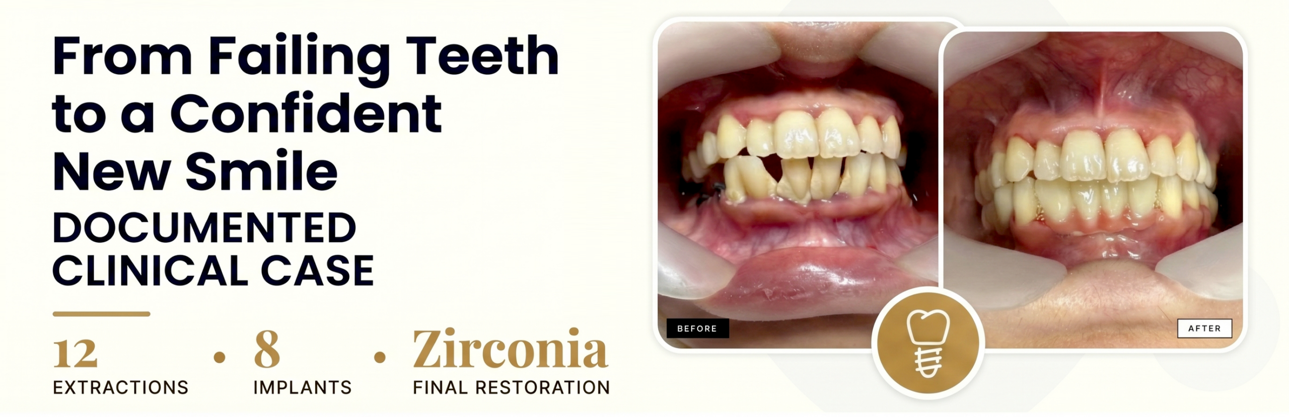 dental implant before after