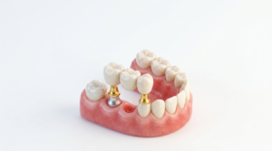 dental bridge