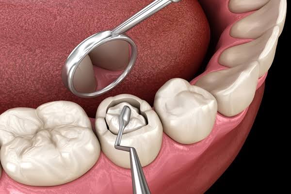 tooth filling