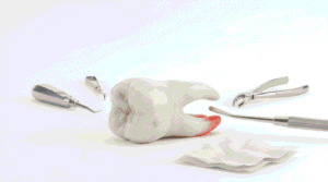 wisdom tooth extraction (1)