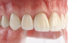 zirconia crown price pakistan