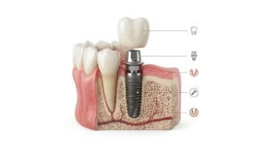 dental implant strucuture