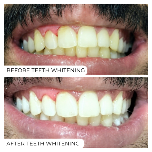 Before After-07