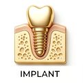 IMPLANT